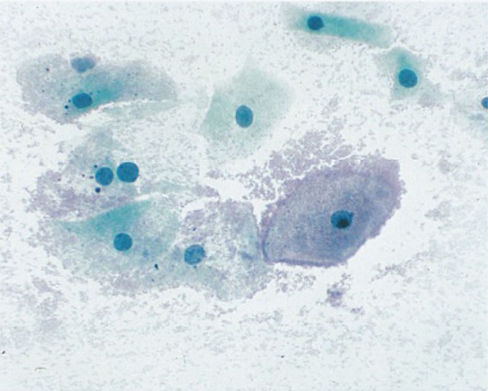 What is predominance of coccobacilli consistent with shift in flora